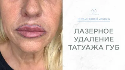 Лазерное удаление перманентного макияжа губ - YouTube