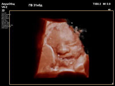 3-D УЗИ. Трехмерное ультразвуковое исследование плода - УЗИ при  беременности в Гомеле