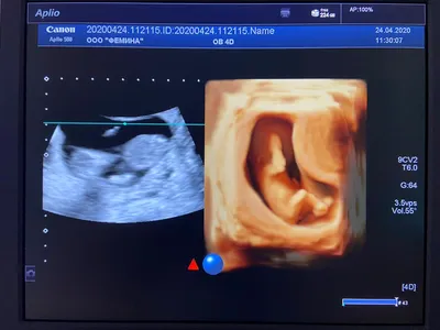 УЗИ 3 D/4-D во время беременности » Фемина 33