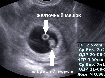 УЗИ плода — цены в клинике «ИнТайм»