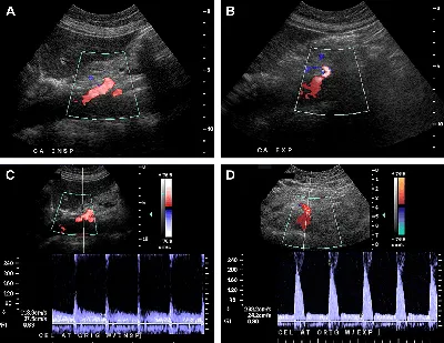 ПОДБОРКА ИНТЕРЕСНЫХ СЛУЧАЕВ ДОППЛЕРОГРАФИЧЕСКОГО ОБСЛЕДОВАНИЯ БРЮШНОЙ  ПОЛОСТИ