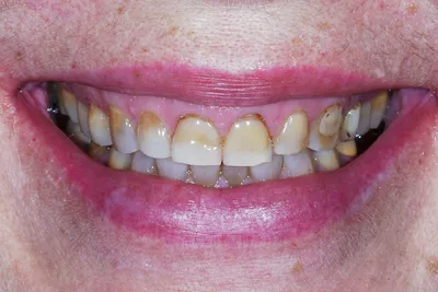 Голливудская улыбка для ухоженной женщины - одна из лучших работ  стоматологов Дентики