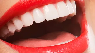 Голливудская улыбка - сколько стоят идеальные зубы