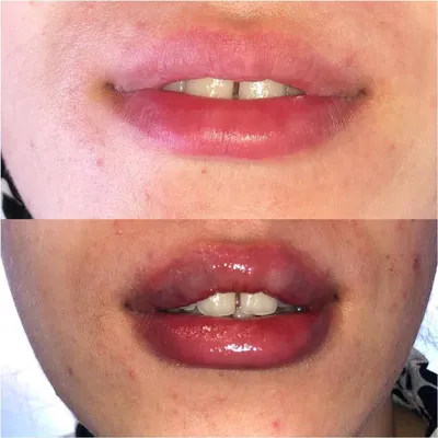 Осложнения после увеличения губ — JEScosmetology