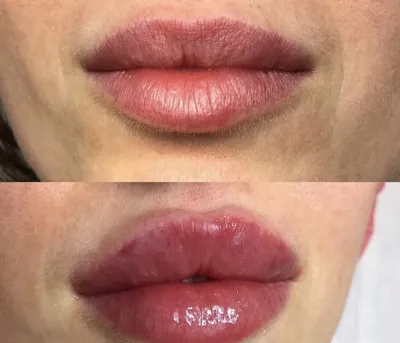 Отек после увеличения губ: причины появления и рекомендации