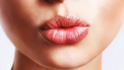 Увеличение губ гиалуроновой кислотой: всё о том как накачать губы  гиалуроновой кислотой, цены, стоимость, за и против уколов - Клиника  красоты Bellezza Киев