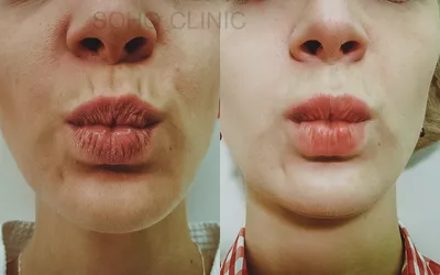 Увеличение губ гиалуроновой кислотой фото до и после — Sohoclinic