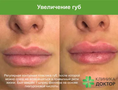Увеличение губ гиалуроновой кислотой в СПб в клинике \"Доктор\"
