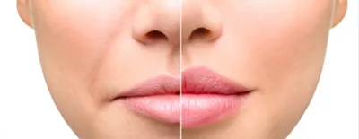Увеличение губ: контурная пластика и коррекция филлерами узких губ