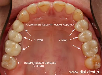Поэтапная реставрация зубов
