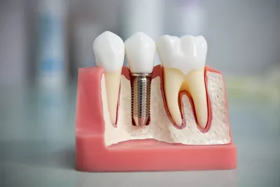 Протезирование зубов: виды зубных протезов, плюсы и минусы