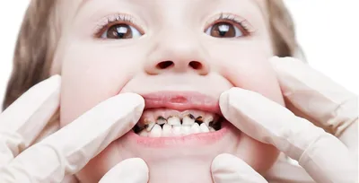 Восстановить все зубы при помощи имплантов. Стоимость тотального  протезирования зубов Харьков 2022