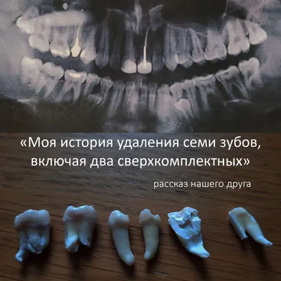 Стоматологическое лечение зубов под общим наркозом седация азотом в  Екатеринбурге от 4500р.