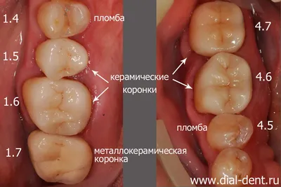 Комплексное лечение зубов