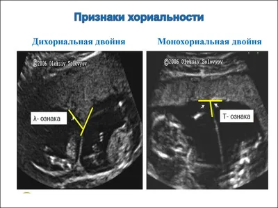 Многоплодная беременность – симптомы, признаки, диагностика и лечение в  клинике «Будь Здоров»