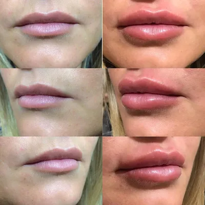 Парижские губы: описание французской техники увеличения с фото до и после