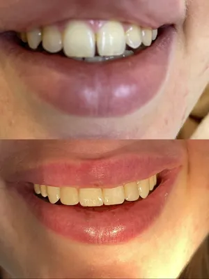 Реставрация зубов Киев
