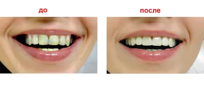 Художественная реставрация зубов до и после фото