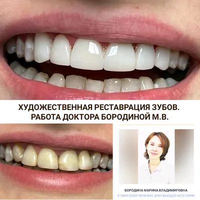 Художественная реставрация зубов, наращивание и восстановление зубов