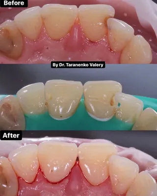 Реставрация зубов - стоимость художественной реставрации зубов на Оболони  (Киев), композитная реставрация зубов - цена в Стоматологии Альфа+ |  Stomatclinica