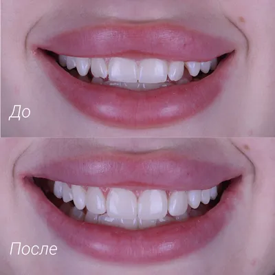 Художественная реставрация зубов в Москве [цена от 6000₽]