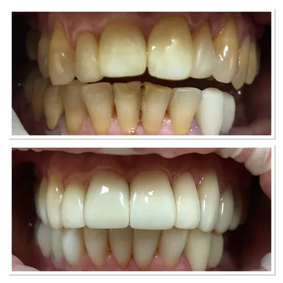 Стоматологические работы по эстетической и художественной реставрации зубов  композитными материаллами, пломбирование зубов, фото до и после