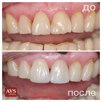 Художественная реставрация зубов в Киеве 🦷 Цены Дарница | iStomatolog