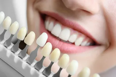 Художественная реставрация зубов Киев ᐉ Стоматология Dental Art