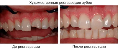 Реставрация зубов: что делать если откололся зуб, к какому доктору  обратиться?
