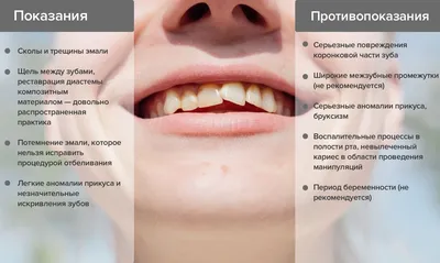 Композитная реставрация зубов в Москве по низким ценам - клиника «Элль-Вояж»