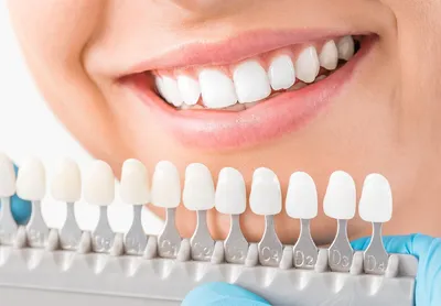 Цвет зубов: какие тона существуют и от чего зависят? | Стоматология  \"Вэладент\" | Дзен
