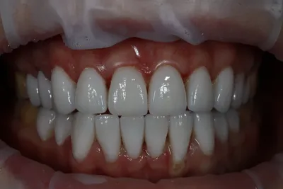 Виниры e-max улучшили форму зубов - стоматология Церекон, Москва