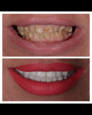 Цвет зубов а1 фото