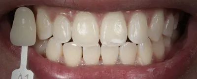 Отбеливание зубов в Киеве 🦷 Профессиональное отбеливание зубов |  iStomatolog