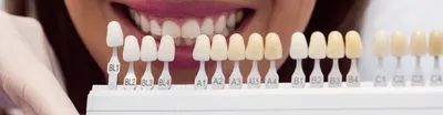 👨 Виниры на все зубы стоимость сколько стоят | Стоматологическая клиника  Дантист