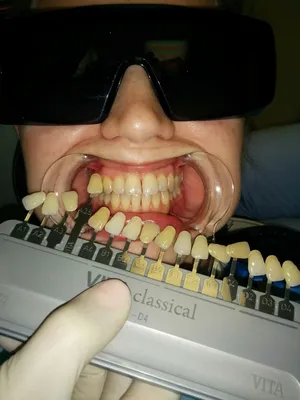 Стоматология «Адента» приглашает сыктывкарцев на новую услугу - отбеливание  зубов Amazing White