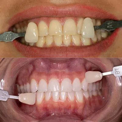 Відбілювання зубів Київ: ціна в стоматології Доброзуб