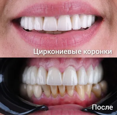 Циркониевые коронки - цена от 4 000 рублей в 3D стоматологии Сочи