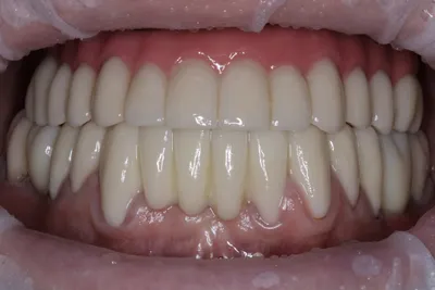 Восстановление зубов путём имплантации и условно cъемной конструкцией из  диоксида циркония - Стоматологическая клиника Дента-Вэст