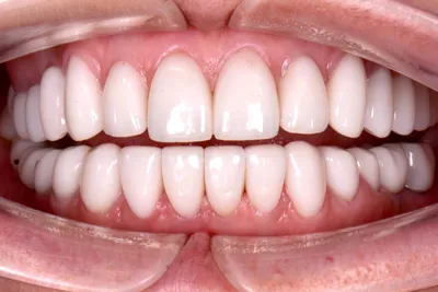 Циркониевые коронки на зубы с гарантией 25 лет, цена от 38000₽ за 1 зуб
