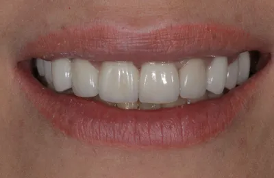 Циркониевые коронки для зубов: сколько стоит - фото до и после