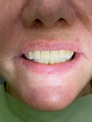 Циркониевые коронки 12-22 зубы | Примеры работ - фото до и после