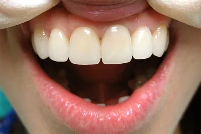 Какие коронки подходят для передних зубов?