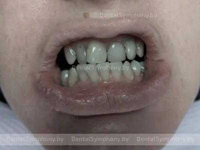 Циркониевые коронки — «Зубная симфония» — пример работы 10