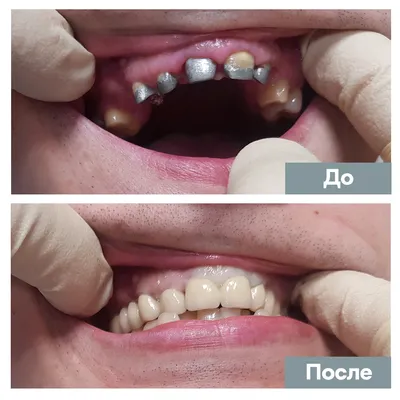 Виниры и циркониевые коронки - Ортодонтия и Детская стоматология