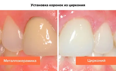 Имплантация и постоянная циркониевая коронка в области 21 зуба | Примеры  работ - фото до и после