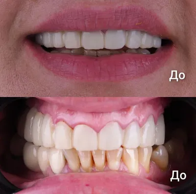 Виниры - Примеры работ сети стоматологий 401