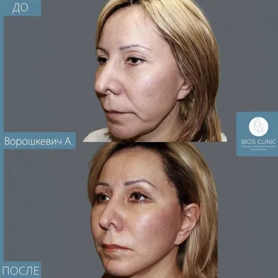 Как подтяжка лица меняет внешность женщины: реальные фото до и после |  DOCTORPITER