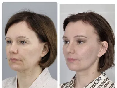 Эндоскопическая подтяжка лица до и после фото