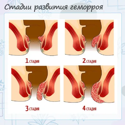 Как выглядит ГЕМОРРОЙ: фото 1-4 стадии. Симптомы геморроя у мужчин и женщин  - YouTube